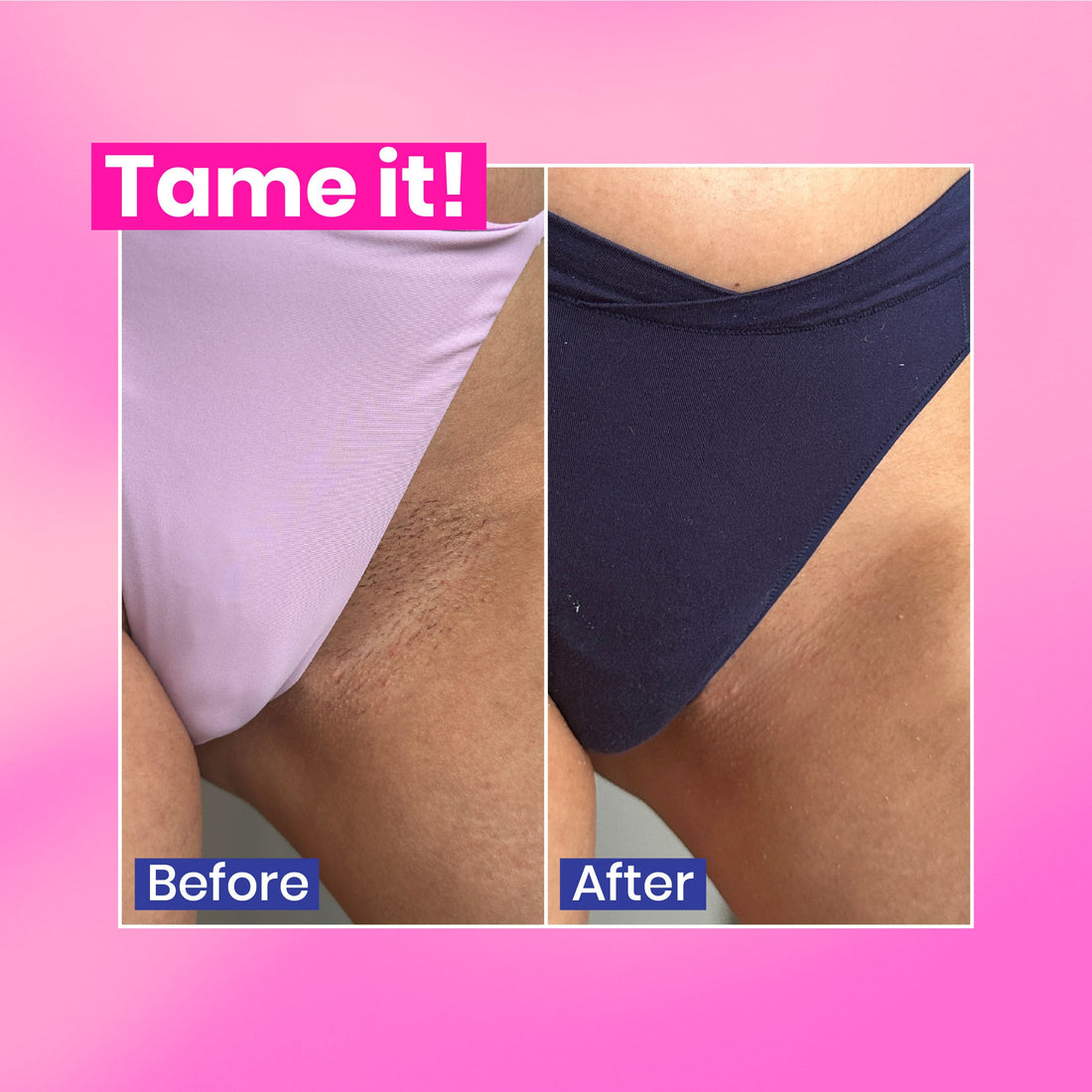 Two photographs of bikini area hair before and after